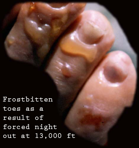 Frostbite